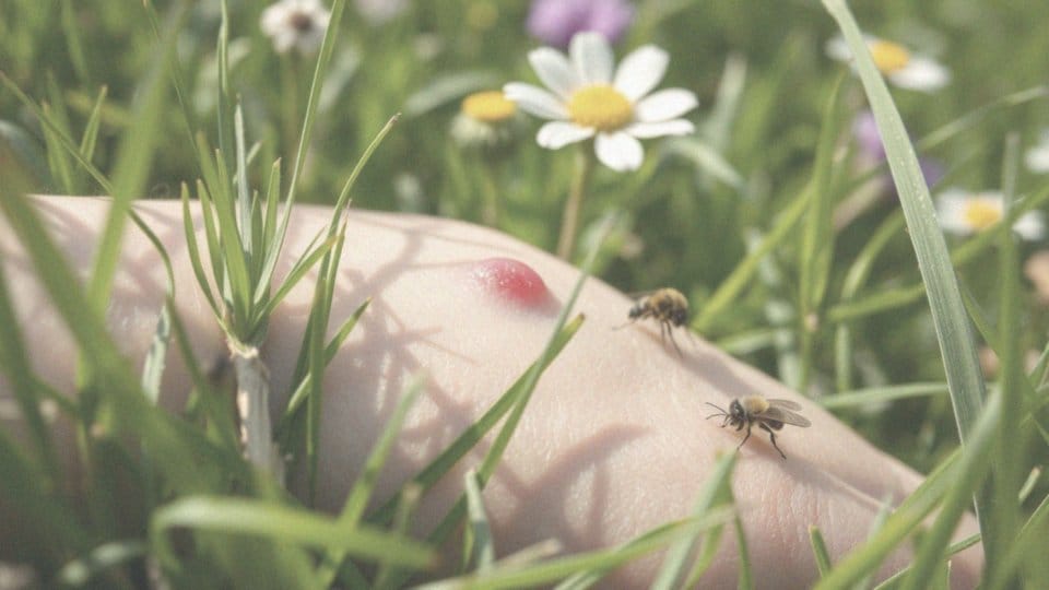 Jakie są różnice w reakcjach skórnych między ukąszeniem komara a ugryzieniem pszczoły?